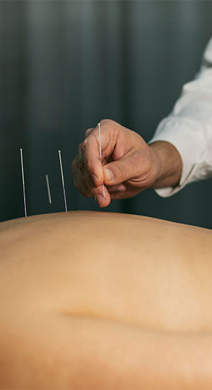 TCM Acupuncture